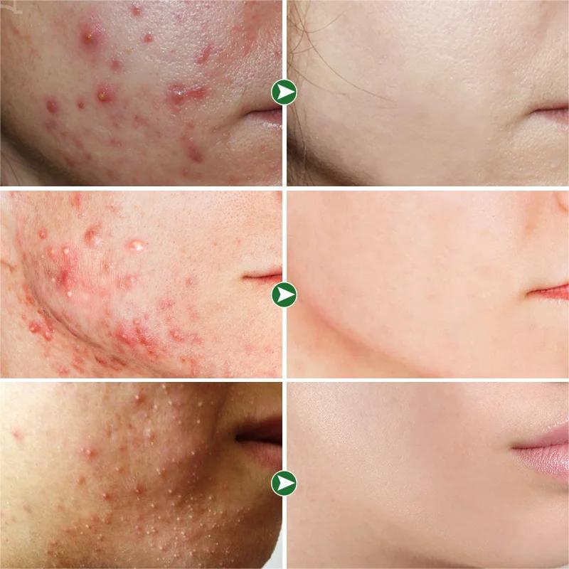 CREMA ANTI ACNÉ BIOAQUA